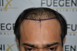 1_Dr.-Munib-Ahmad-2560g-From-Insecure-with-a-Hairsystem-to-Confident-Young-Man-1