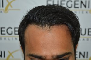 2_Dr.-Munib-Ahmad-2560g-From-Insecure-with-a-Hairsystem-to-Confident-Young-Man-11