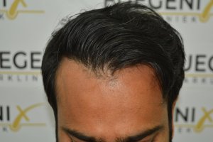 2_Dr.-Munib-Ahmad-2560g-From-Insecure-with-a-Hairsystem-to-Confident-Young-Man-12