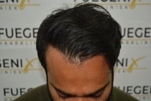 2_Dr.-Munib-Ahmad-2560g-From-Insecure-with-a-Hairsystem-to-Confident-Young-Man-13