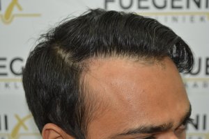 2_Dr.-Munib-Ahmad-2560g-From-Insecure-with-a-Hairsystem-to-Confident-Young-Man-17