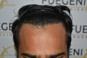 2_Dr.-Munib-Ahmad-2560g-From-Insecure-with-a-Hairsystem-to-Confident-Young-Man-18