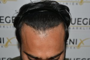 2_Dr.-Munib-Ahmad-2560g-From-Insecure-with-a-Hairsystem-to-Confident-Young-Man-20