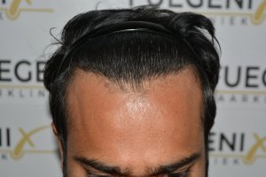 2_Dr.-Munib-Ahmad-2560g-From-Insecure-with-a-Hairsystem-to-Confident-Young-Man-21
