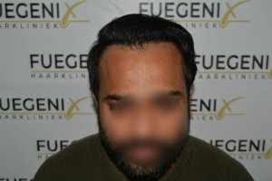 2_Dr.-Munib-Ahmad-2560g-From-Insecure-with-a-Hairsystem-to-Confident-Young-Man-27
