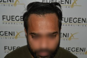 2_Dr.-Munib-Ahmad-2560g-From-Insecure-with-a-Hairsystem-to-Confident-Young-Man-28