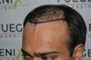 2_Dr.-Munib-Ahmad-2560g-From-Insecure-with-a-Hairsystem-to-Confident-Young-Man-3