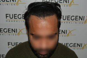2_Dr.-Munib-Ahmad-2560g-From-Insecure-with-a-Hairsystem-to-Confident-Young-Man-30