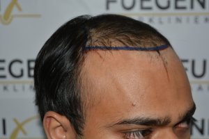 2_Dr.-Munib-Ahmad-2560g-From-Insecure-with-a-Hairsystem-to-Confident-Young-Man-4