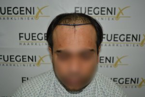 2_Dr.-Munib-Ahmad-2560g-From-Insecure-with-a-Hairsystem-to-Confident-Young-Man-5