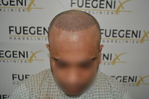 2_Dr.-Munib-Ahmad-2560g-From-Insecure-with-a-Hairsystem-to-Confident-Young-Man-9