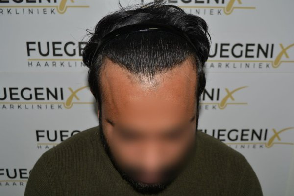 2_Dr.-Munib-Ahmad-2560g-From-Insecure-with-a-Hairsystem-to-Confident-Young-Man-32