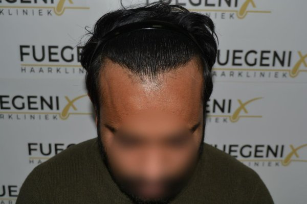 2_Dr.-Munib-Ahmad-2560g-From-Insecure-with-a-Hairsystem-to-Confident-Young-Man-34