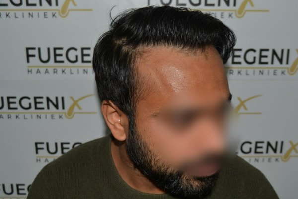 2_Dr.-Munib-Ahmad-2560g-From-Insecure-with-a-Hairsystem-to-Confident-Young-Man-37