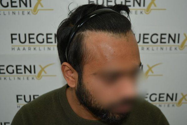 2_Dr.-Munib-Ahmad-2560g-From-Insecure-with-a-Hairsystem-to-Confident-Young-Man-38