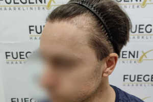 Failed-Temple-and-Hairline-Repaired-in-One-Sitting-3