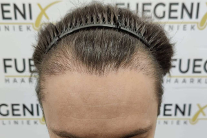 Failed-Temple-and-Hairline-Repaired-in-One-Sitting-5
