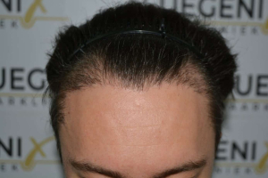 Failed-Temple-and-Hairline-Repaired-in-One-Sitting-6