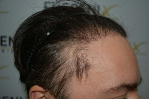 Failed-Temple-and-Hairline-Repaired-in-One-Sitting-9