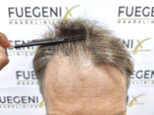 Cowlick-Hairline-2-Whirled-Crown-2-Big-Scars-1-Drainhole-in-One-Surgery-1