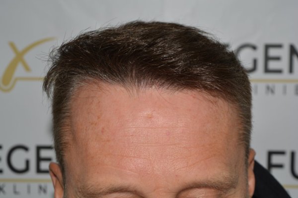 Cowlick-Hairline-2-Whirled-Crown-2-Big-Scars-1-Drainhole-in-One-Surgery-24
