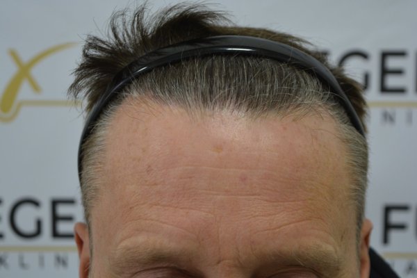 Cowlick-Hairline-2-Whirled-Crown-2-Big-Scars-1-Drainhole-in-One-Surgery-33