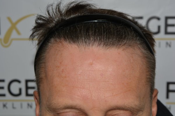 Cowlick-Hairline-2-Whirled-Crown-2-Big-Scars-1-Drainhole-in-One-Surgery-34