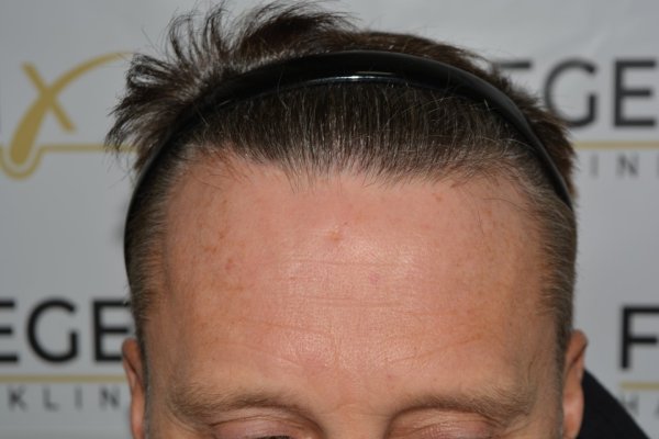 Cowlick-Hairline-2-Whirled-Crown-2-Big-Scars-1-Drainhole-in-One-Surgery-35