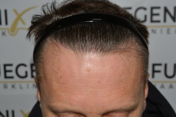 Cowlick-Hairline-2-Whirled-Crown-2-Big-Scars-1-Drainhole-in-One-Surgery-36