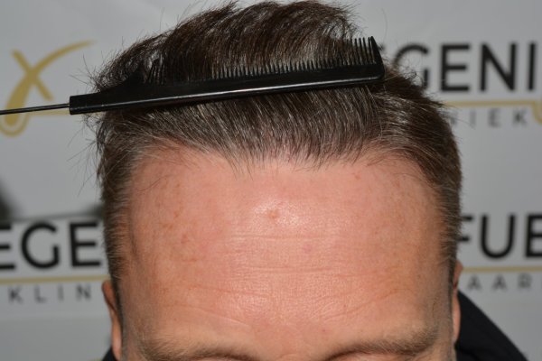 Cowlick-Hairline-2-Whirled-Crown-2-Big-Scars-1-Drainhole-in-One-Surgery-40