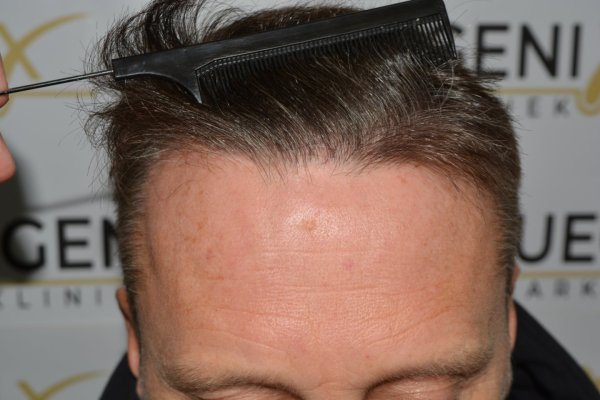 Cowlick-Hairline-2-Whirled-Crown-2-Big-Scars-1-Drainhole-in-One-Surgery-41