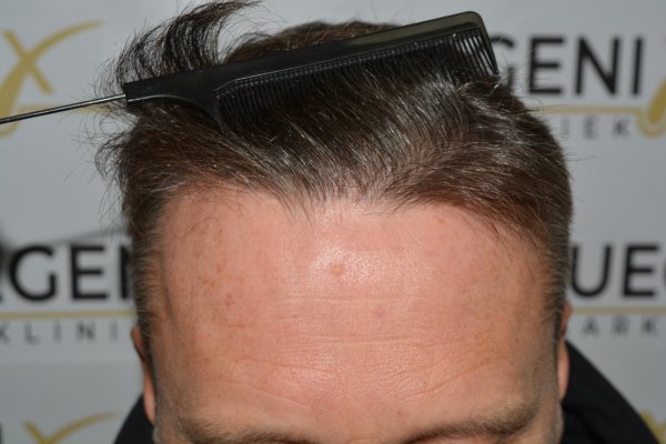Cowlick-Hairline-2-Whirled-Crown-2-Big-Scars-1-Drainhole-in-One-Surgery-42