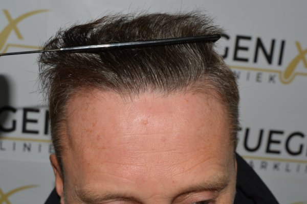 Cowlick-Hairline-2-Whirled-Crown-2-Big-Scars-1-Drainhole-in-One-Surgery-43