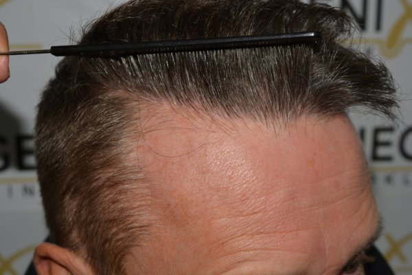 Cowlick-Hairline-2-Whirled-Crown-2-Big-Scars-1-Drainhole-in-One-Surgery-45