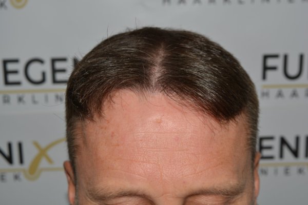 Cowlick-Hairline-2-Whirled-Crown-2-Big-Scars-1-Drainhole-in-One-Surgery-49