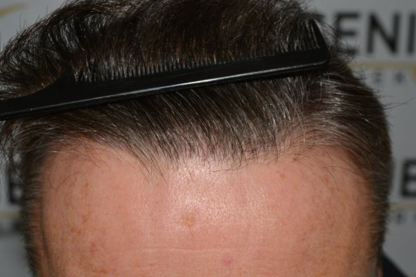 Cowlick-Hairline-2-Whirled-Crown-2-Big-Scars-1-Drainhole-in-One-Surgery-70