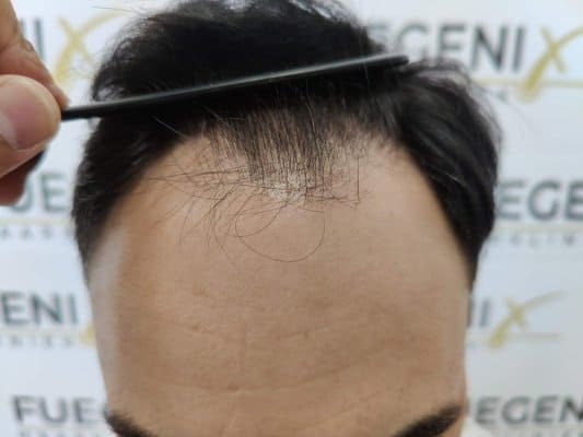 The-Bollywood-Hairline-1