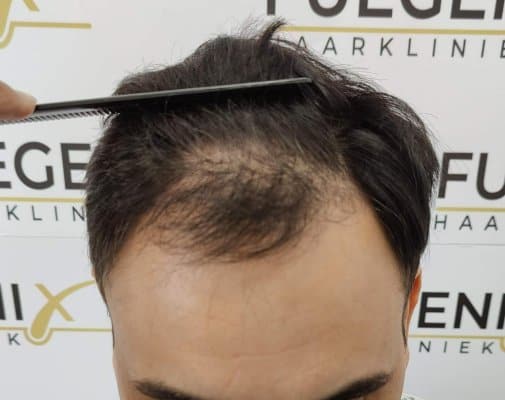 The-Bollywood-Hairline-4
