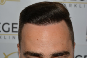 The Hairline That You Dream Of