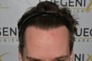 The Henry Cavill Hairline