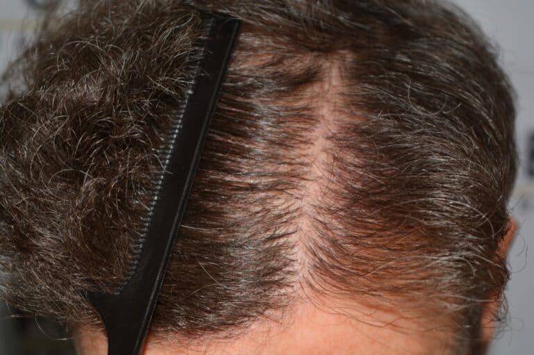 Dr. Munib Ahmad 2645g - Curly Hairline